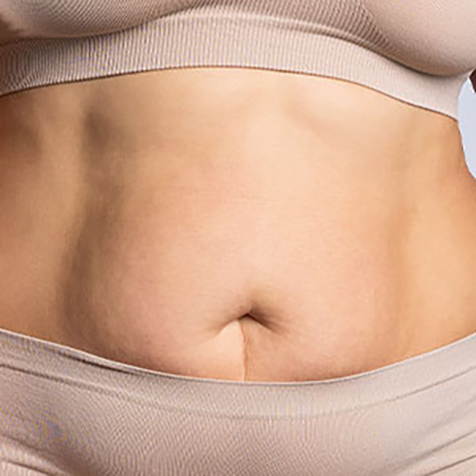 Stubborn Fat treatment options at SF Bay Cosmetic Surgery Medical Group in San Ramon
