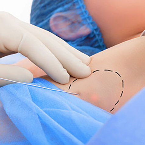 Treat cellulite with our Thermitight® at SF Bay Cosmetic Surgery Medical Group in San Ramon