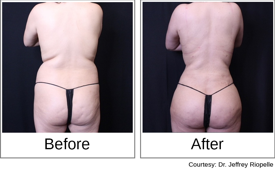 Brazilian Butt Lift Before and After 0